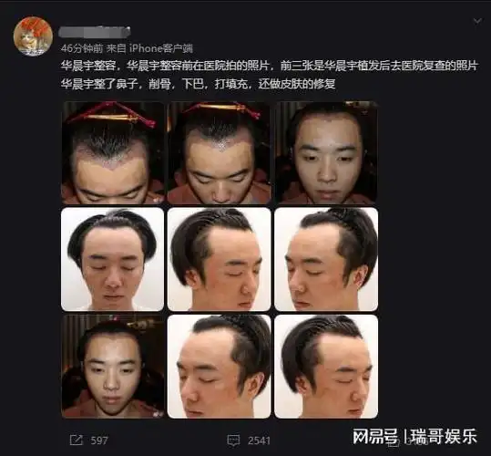 7月16日,一名网友爆出华晨宇植发照片,并称:张碧晨是"小三"