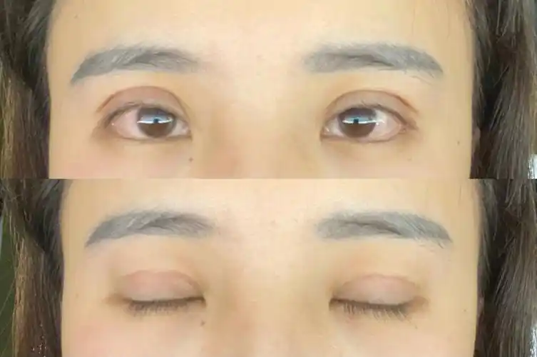 全切双眼皮第13天