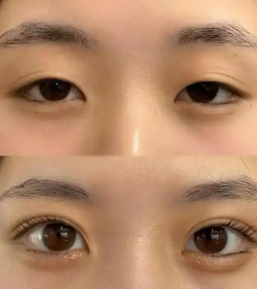 窄平行,爆改垂垂眼.肌无力看着就是一副没睡醒的样子