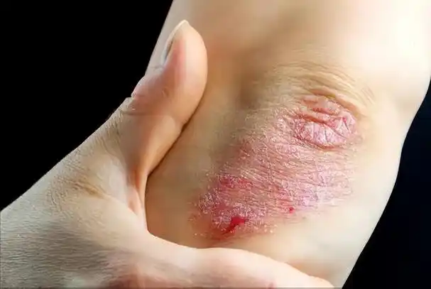 13种常见皮肤病的联合用药方案!便宜实用,只发一次,需要的收好