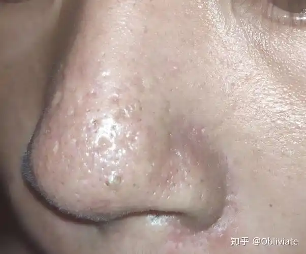 挤黑头是一种什么样的感受