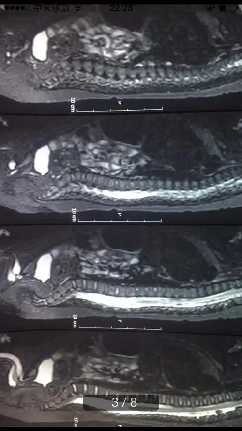 跪求助宝宝四个月脊髓中央管轻度扩张意味着什么
