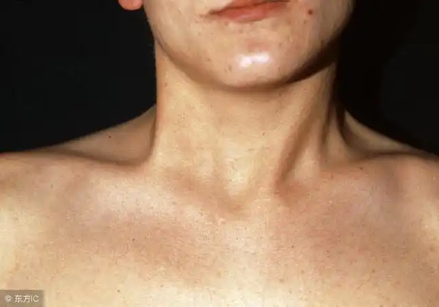 先天性肌性斜颈有哪些病因和表现?