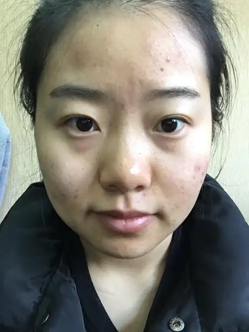 十几年的痘龄,时好时坏,皮肤状态非常差,怎么改善或治疗,有通过医美治