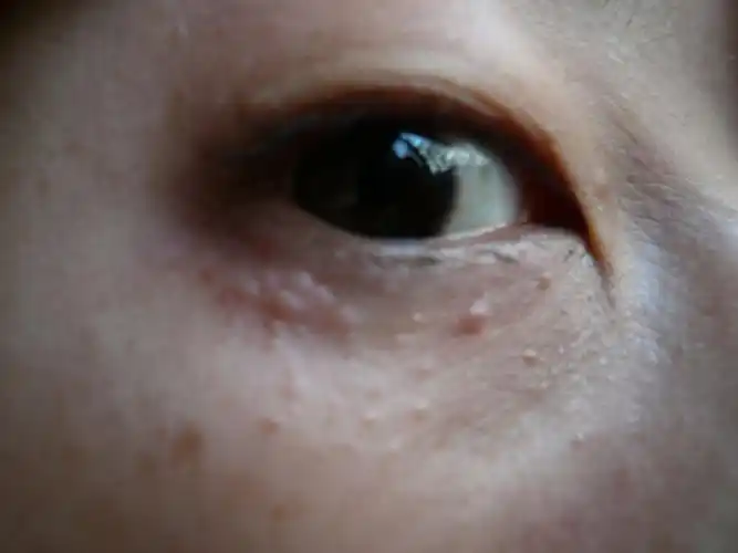 上下眼皮张很多小疙瘩很长时间也没掉