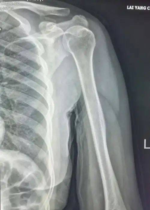 肩部背部外伤要注意肩胛骨,肩关节正位不宜观察,可以结合斜位,最好ct