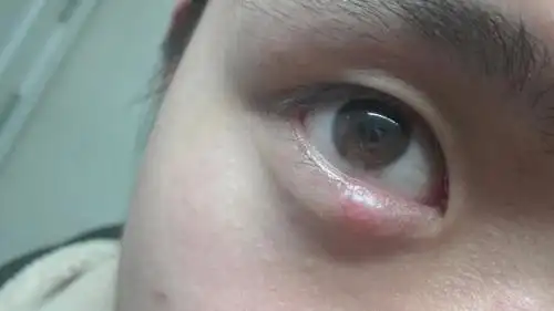 左眼下眼皮跳怎么回事相关文章