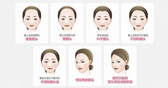 你好,发际线种植可以设计形状的,发际线种植是根据我们自己的三臀五