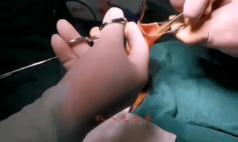 手术演示丨吻合器包皮环切术