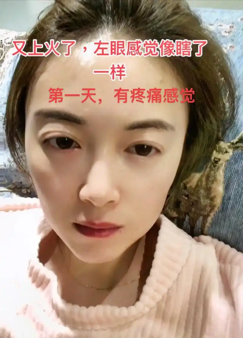 你们都长麦粒肿吗,都和我一样这么严重吗?以前都可以自愈,现在 - 抖音