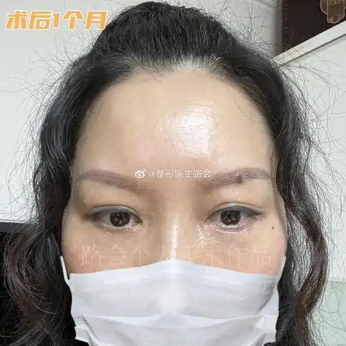 求美者反馈##眼袋泪沟##眼周年轻化##用手术照讲个故事##脂肪泪沟