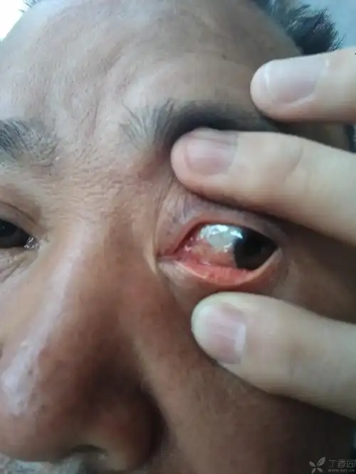 双眼内侧血管充血,角膜表面有白色增生物,双眼干涩,视力无影响 可能