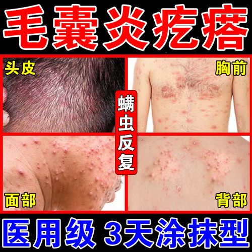 后背祛痘 毛囊炎专用药膏螨虫药膏背部除螨去螨虫后背长痘祛痘背上长