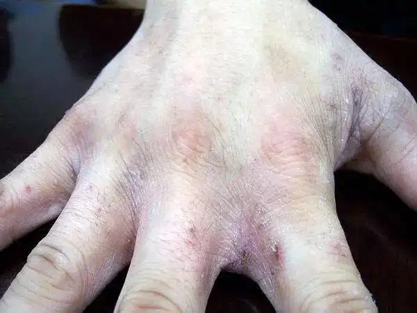 皮肤剧烈瘙痒什么药都不管用?警惕是疥疮