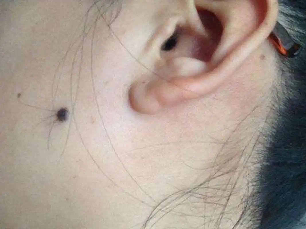 痣上长毛可是好现象!