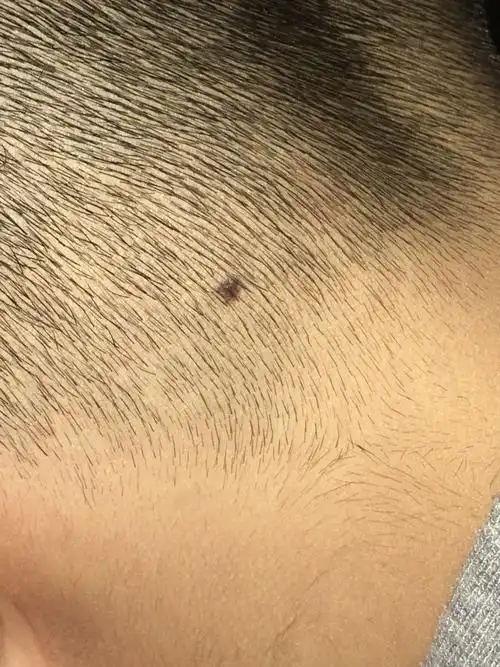 今天看到黑色素瘤的文章,我儿子的头上也有一个痣,我很担心.