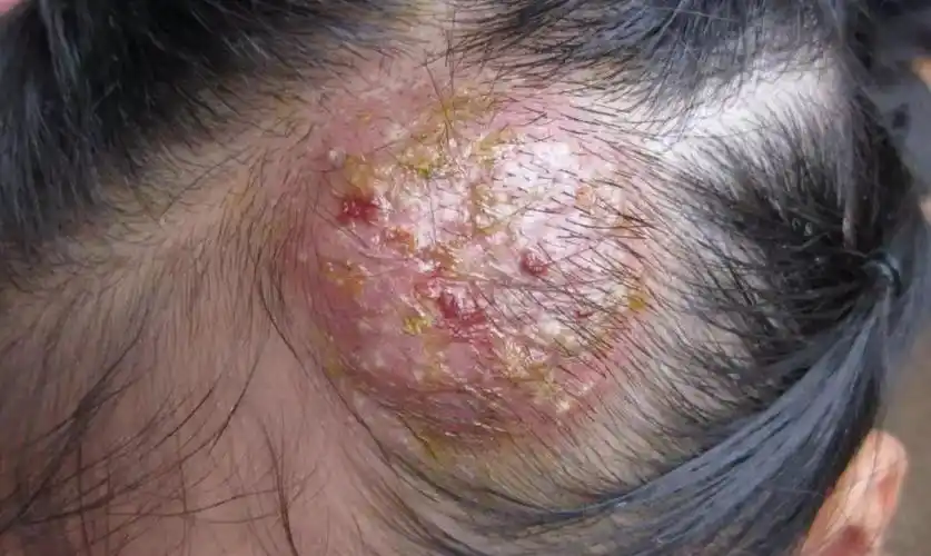 因为养了只宠物兔,却不料感染了兔子身上的真菌,导致整个头皮溃烂流脓