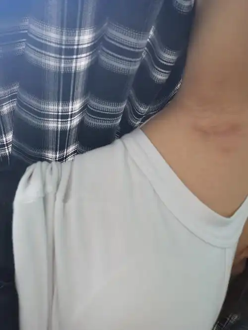 切口恢复得很好,用的医生推荐的疤痕膏,我是腋下切口_圈子-新氧美容