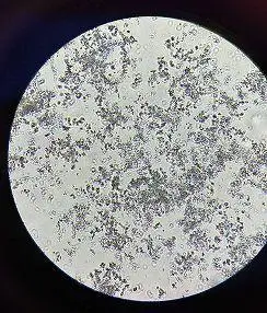 尿呈乳白色,尿常规结果竟然全部正常?|磷酸盐|结晶_网易订阅