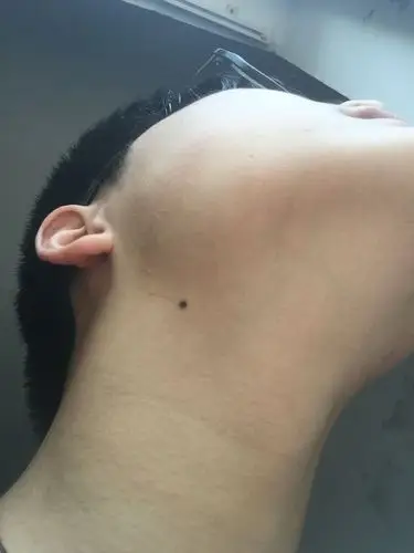 脖子右痣上长毛 向左转  向右转