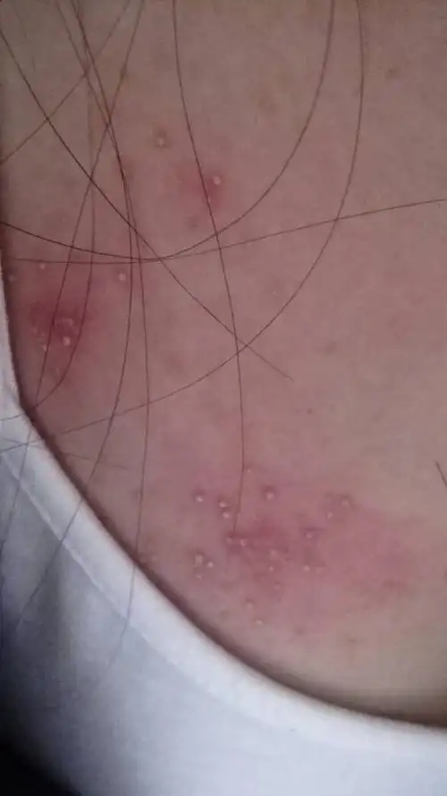 不知道胸部上点张了白白的像脓一样的痘痘,请问那