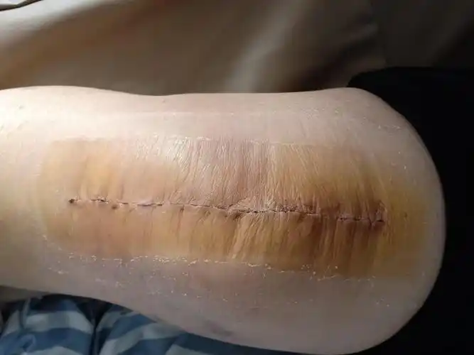 患者术后第六天开始脱助行器行走锻炼!