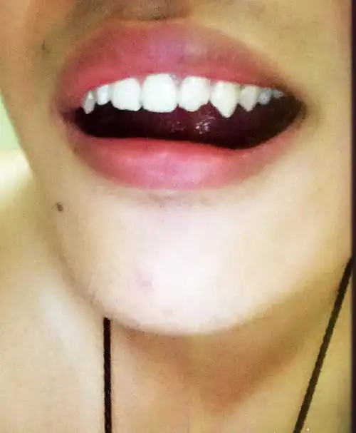 为什么我的牙齿很尖?是不是长歪了?我用不用矫正或者磨平?急