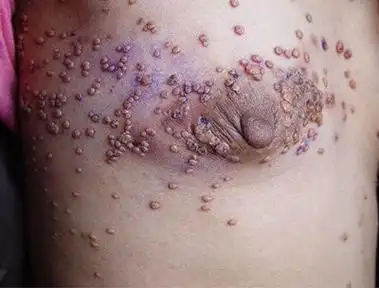 艾滋病的早期症状