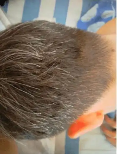 皮友们,我才十七岁白头发就有那么多,还有救吗?该怎么办才好啊