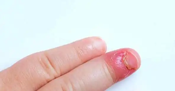 爱咬指甲的孩子最后都长成这样