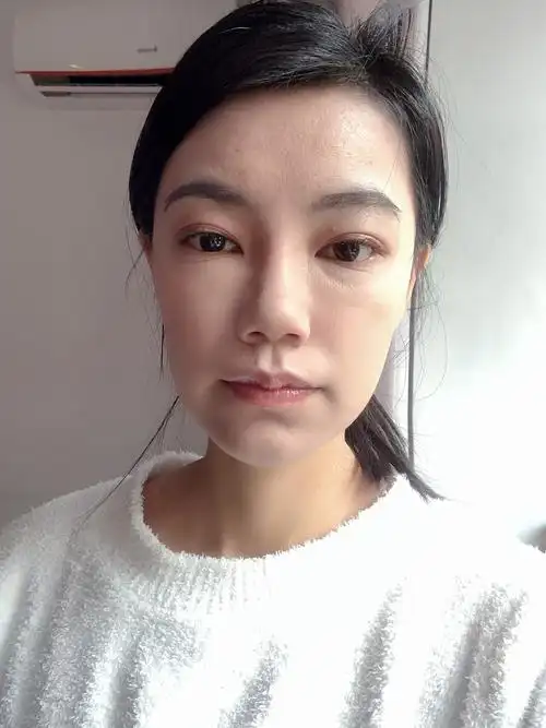 求助 玻尿酸填充泪沟有凸起