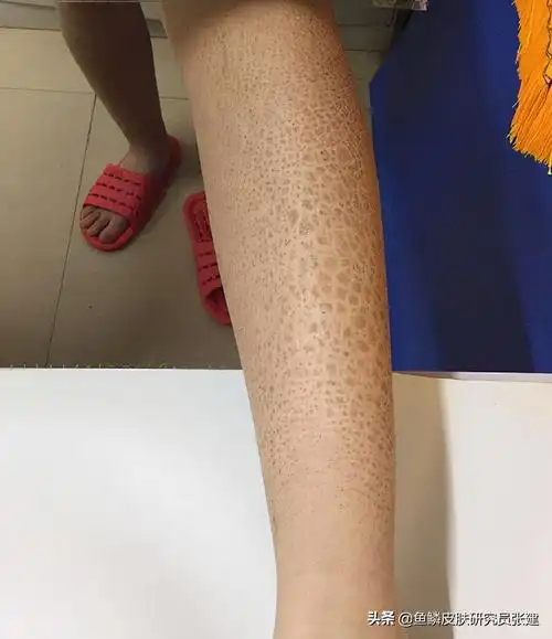 一直困扰我的鱼鳞病终于解决了,这些话想对同样有鱼鳞皮肤的你说