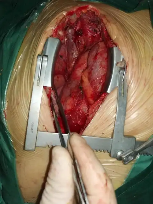 胸外科自主完成一例3d打印正劈胸骨入路疑难纵膈肿瘤切除手术