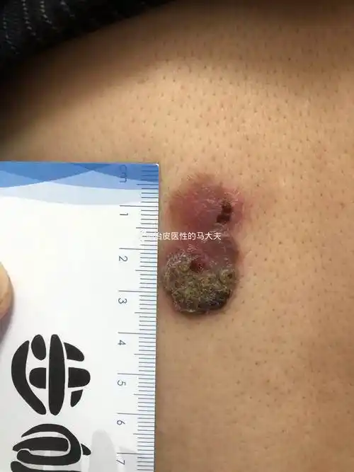 不知名的皮肤肿瘤