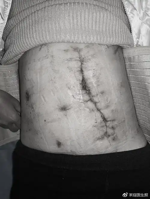 湖南:湘雅二医院多科协作,化险为夷,成功救治严重腹腔容积不足患者