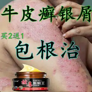 拔毒断癣王专治疗牛皮癣银屑皮肤瘙痒湿疹止痒去根无激素外用药膏