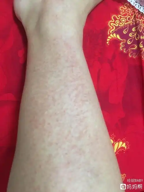 为什么天气会冷皮肤痒痒(为什么天气冷皮肤容易瘙痒)