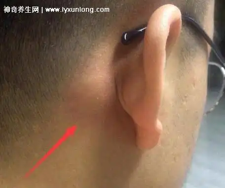 颈部淋巴结肿大图片症状侧面位置会有肿物伴随疼痛感要重视