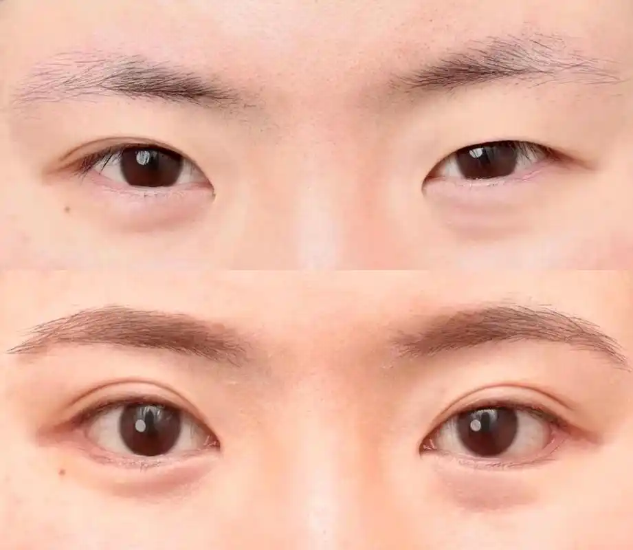 眼皮一单一双,也可以拥有好看的双眼皮