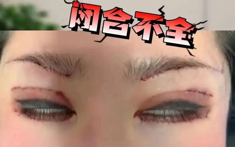 网上失败案例分析:双眼皮手术和切眉术后,眼睛闭合不全!