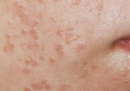 扁平疣轻微前期是什么样子图片大全