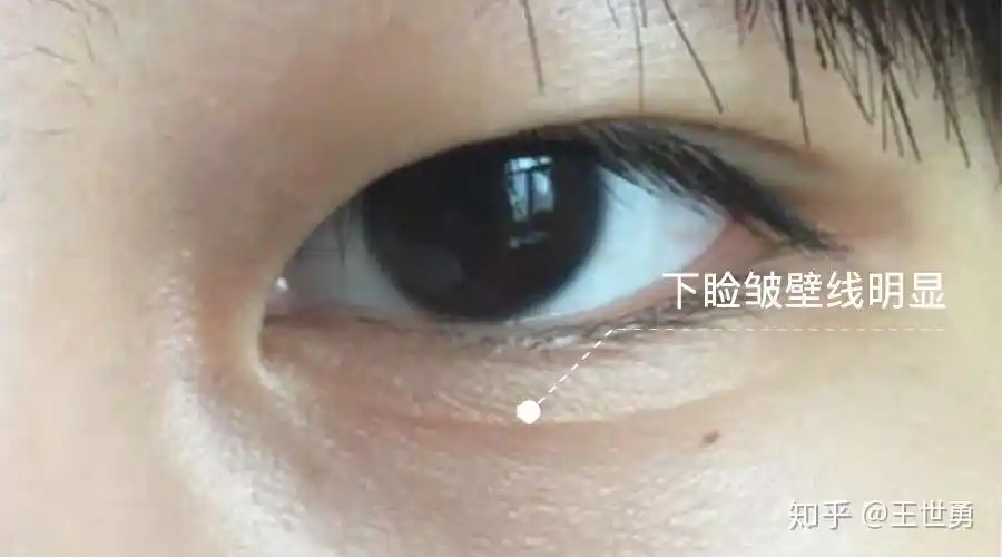 王世勇眼睛的美学系列之三下眼睑之美