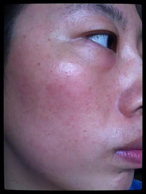你好,我现在的皮肤有红血丝,换季会痒,怎么样才能改善呢,想知道从哪一