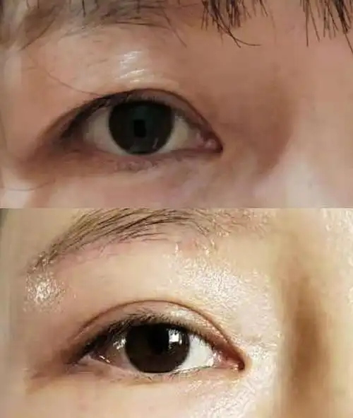 在面诊的过程中,经常有求美者会把上睑松弛误认为是提肌无力,把提肌