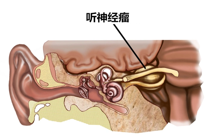 耳鸣眼睛胀痛面部发麻以为是脑梗却检查出听神经瘤