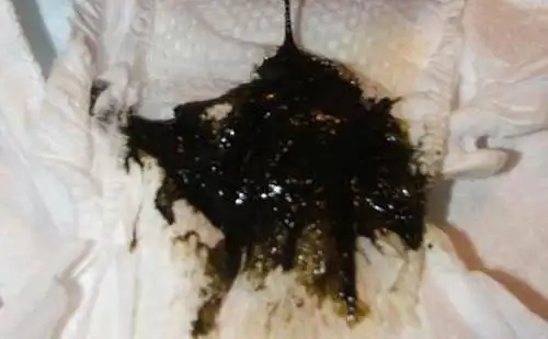 1,黑便或呕血下面这4个信号,一定要重视,说明胃癌已经离你不远据数据