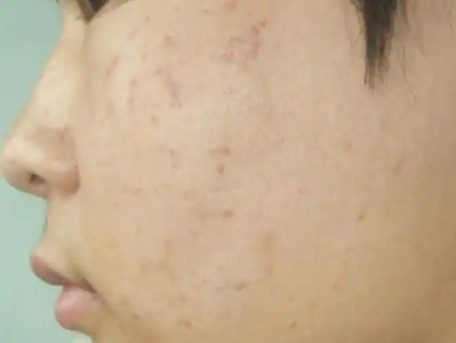 扁平疣初期图片