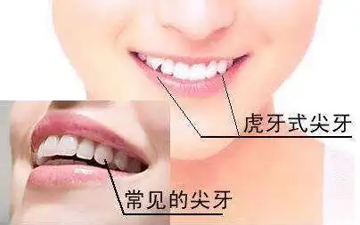 在廊坊虎牙那么可爱为什么不能拔