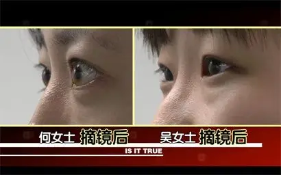 为什么有人近视眼球会特别凸出两位近视患者用亲身实验告诉你