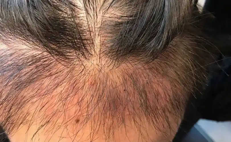 植发后枕部毛囊炎为什么一直好不了_头皮_细菌_手术